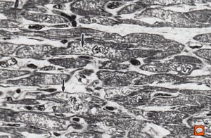 M, 7w. | mitochondrial cardiomyopathy - semithin section(arrows - megamitochondria) M, 7w. | mitochondrial cardiomyopathy - semithin section(arrows - megamitochondria)
